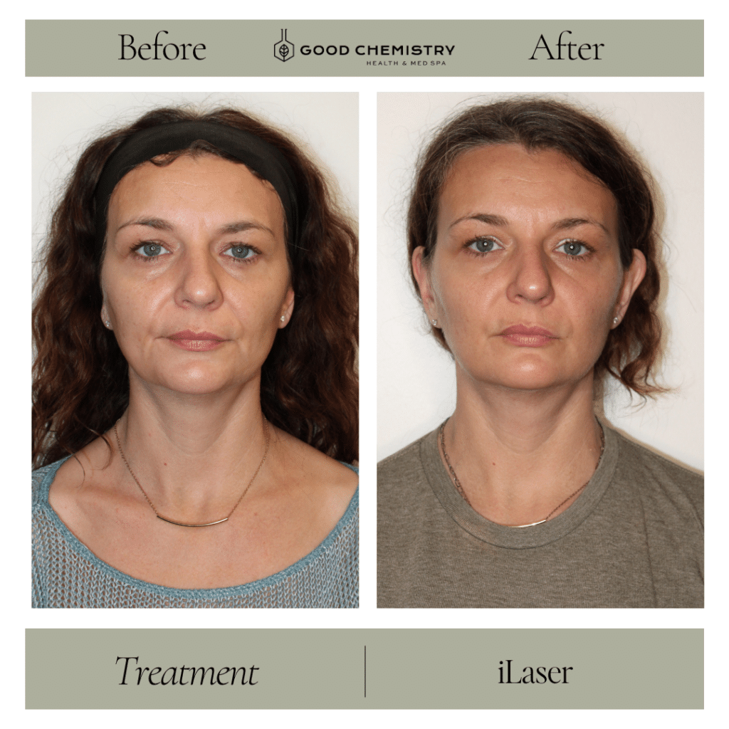 Frontal before and after photos showing iLaser skin tightening results as a non-surgical alternative to a facelift at Good Chemistry Health & Med Spa in Cumming, GA