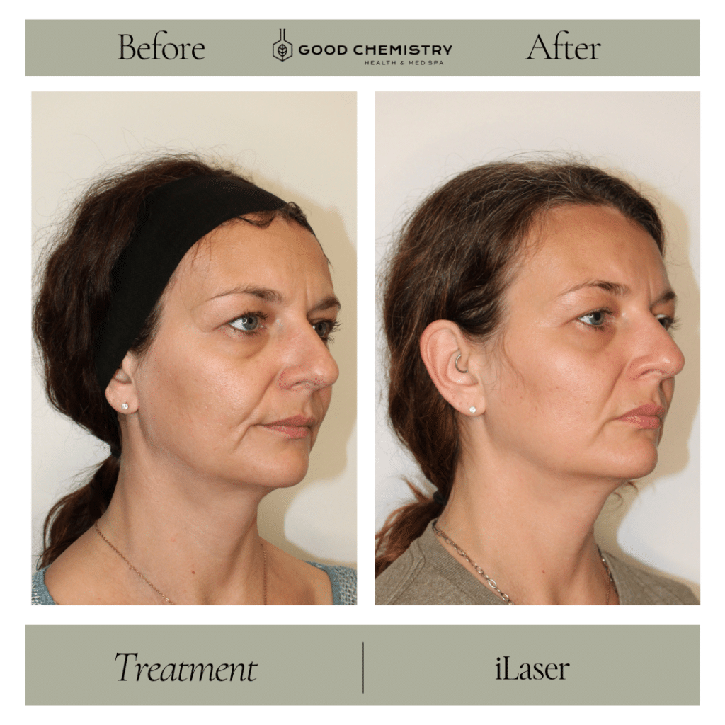 Side-angle before and after photos showing iLaser non-surgical face tightening results including jawline definition at Good Chemistry Health & Med Spa in Cumming, GA